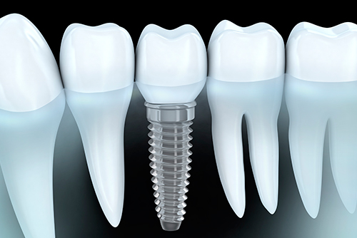 Cirugía Oral e Implantologia avanzada